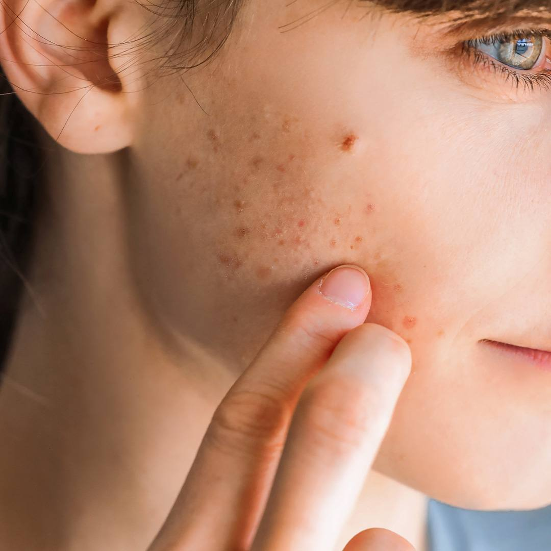 Unguento all'Ittiolo 9,8% 30 ml